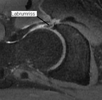 Mr Arthrographie Im Radiologischen Institut Dr Von Essen Radiologisches Institut Dr Von Essen Koblenz Simmern Im Hunsruck